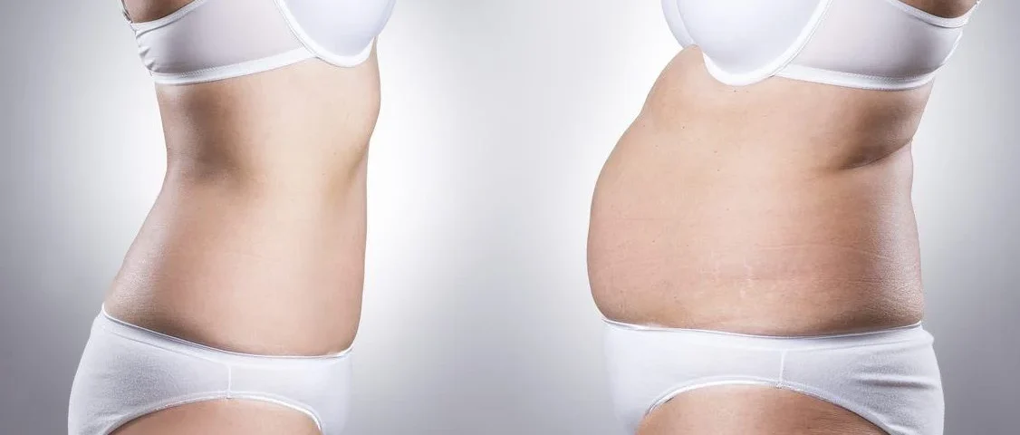 Quelle est la différence entre un bodylift et une abdominoplastie ?