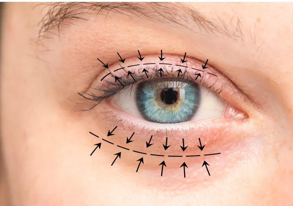 Combien de temps dure une opération des 4 paupières ?