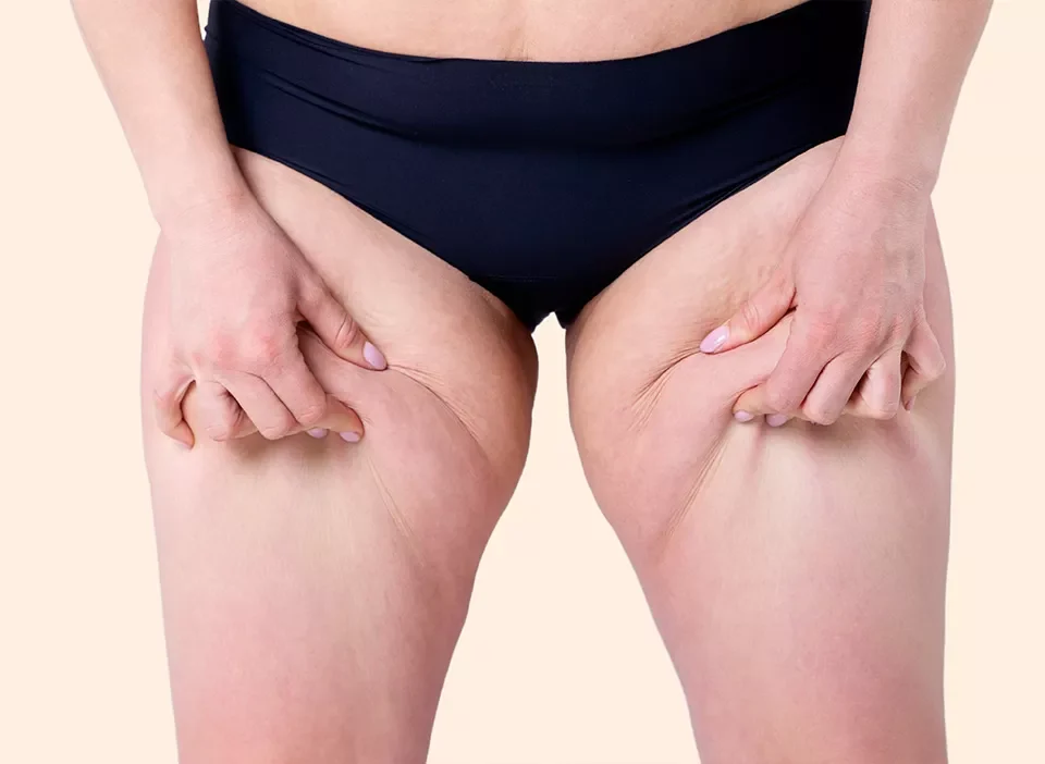 Quel est le traitement chirurgical pour le lipœdème ?