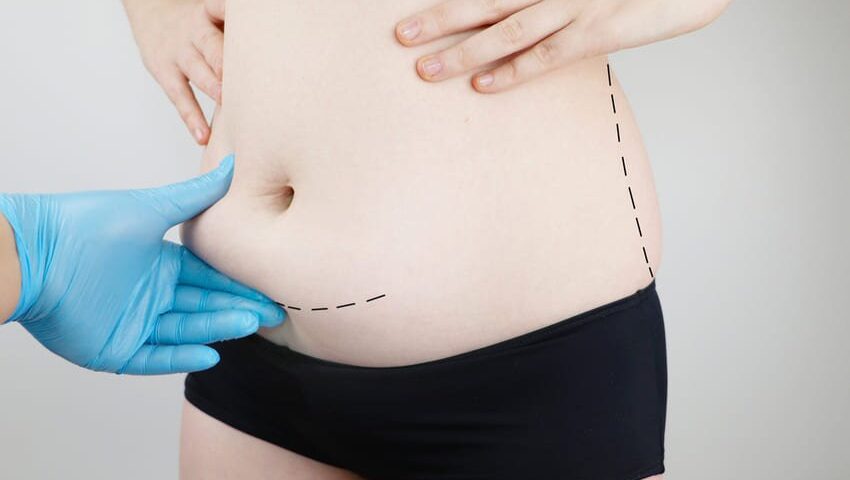 L’abdominoplastie est-elle indiquée chez les patientes atteintes de lipœdème