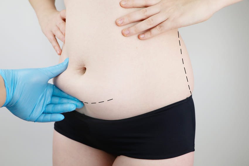 L’abdominoplastie est-elle indiquée chez les patientes atteintes de lipœdème