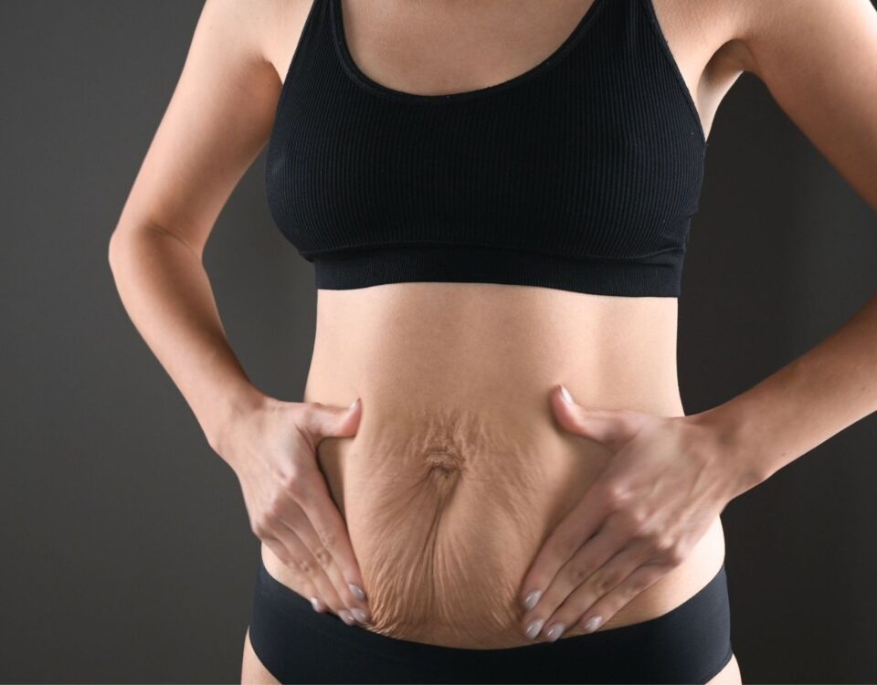 Lifting du ventre après une perte de poids importante