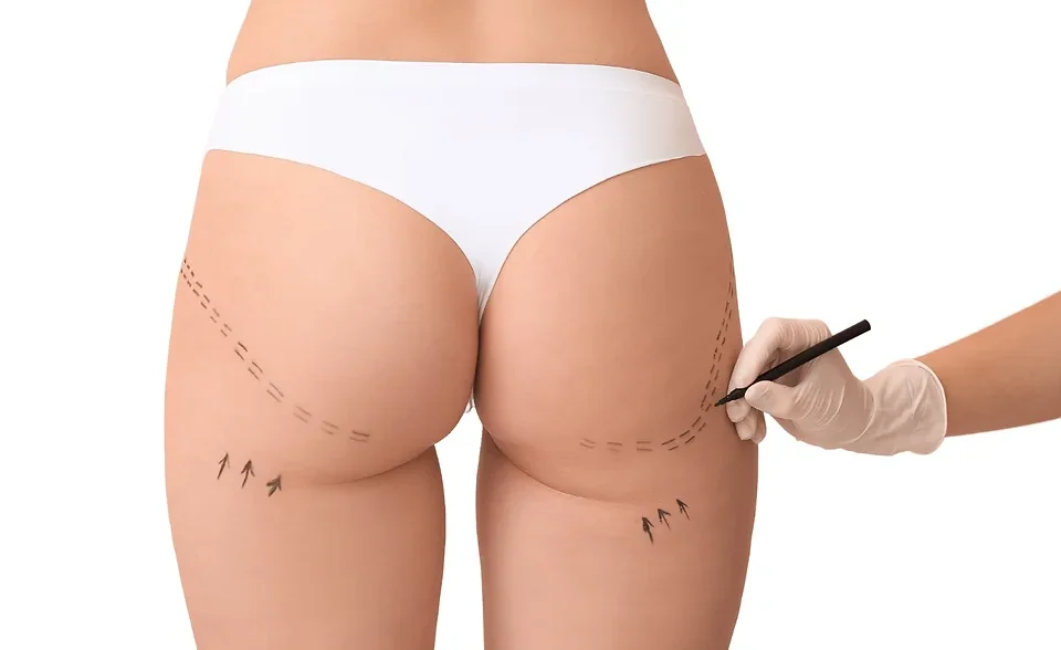 Lifting des fesses + liposuccion