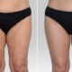 Lifting des cuisses et lipœdème
