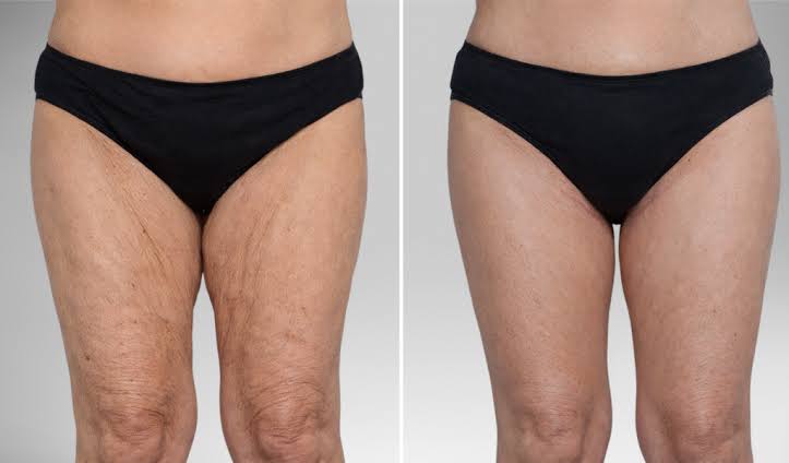 Lifting des cuisses et lipœdème