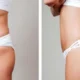 BBL ou body lift après lipœdème