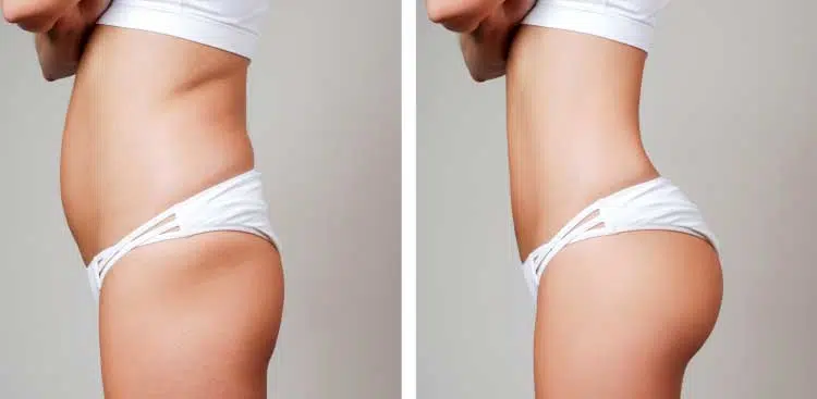 BBL ou body lift après lipœdème