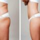 Lifting des fesses avec abdominoplastie