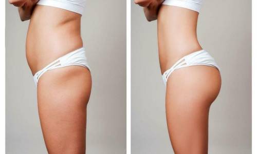 Lifting des fesses avec abdominoplastie
