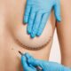 Lifting des seins sans cicatrices visibles
