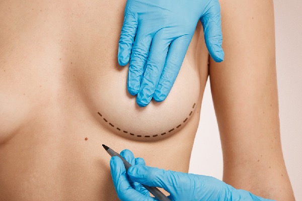 Lifting des seins sans cicatrices visibles