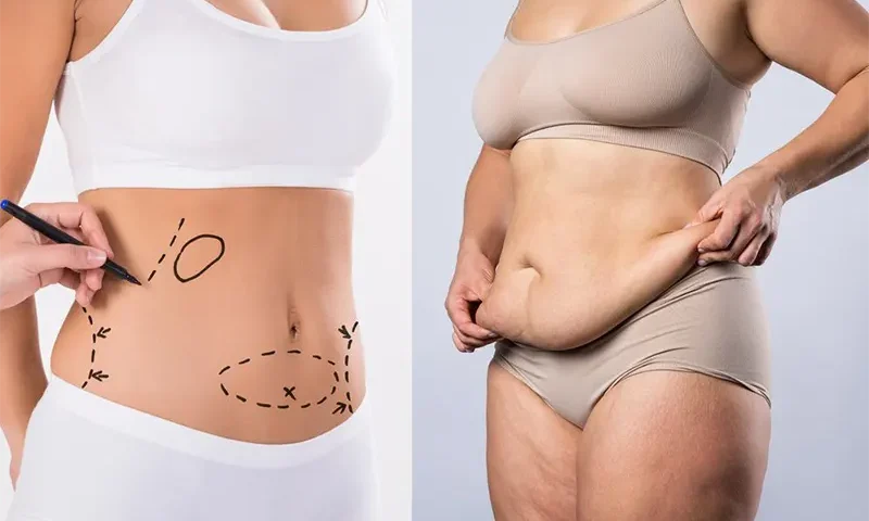 Peut-on réaliser un lifting du ventre après une liposuccion pour traiter le lipœdème ?