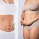 Peut-on réaliser un lifting du ventre après une liposuccion pour traiter le lipœdème ?