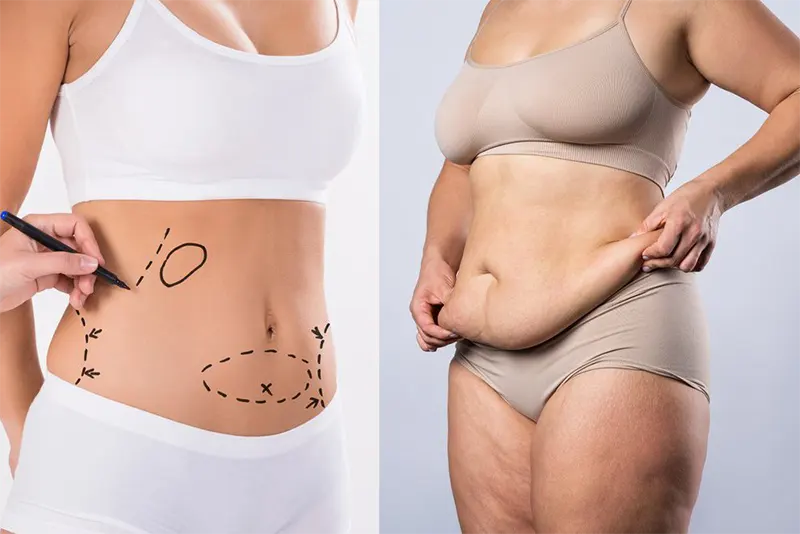 Peut-on réaliser un lifting du ventre après une liposuccion pour traiter le lipœdème ?