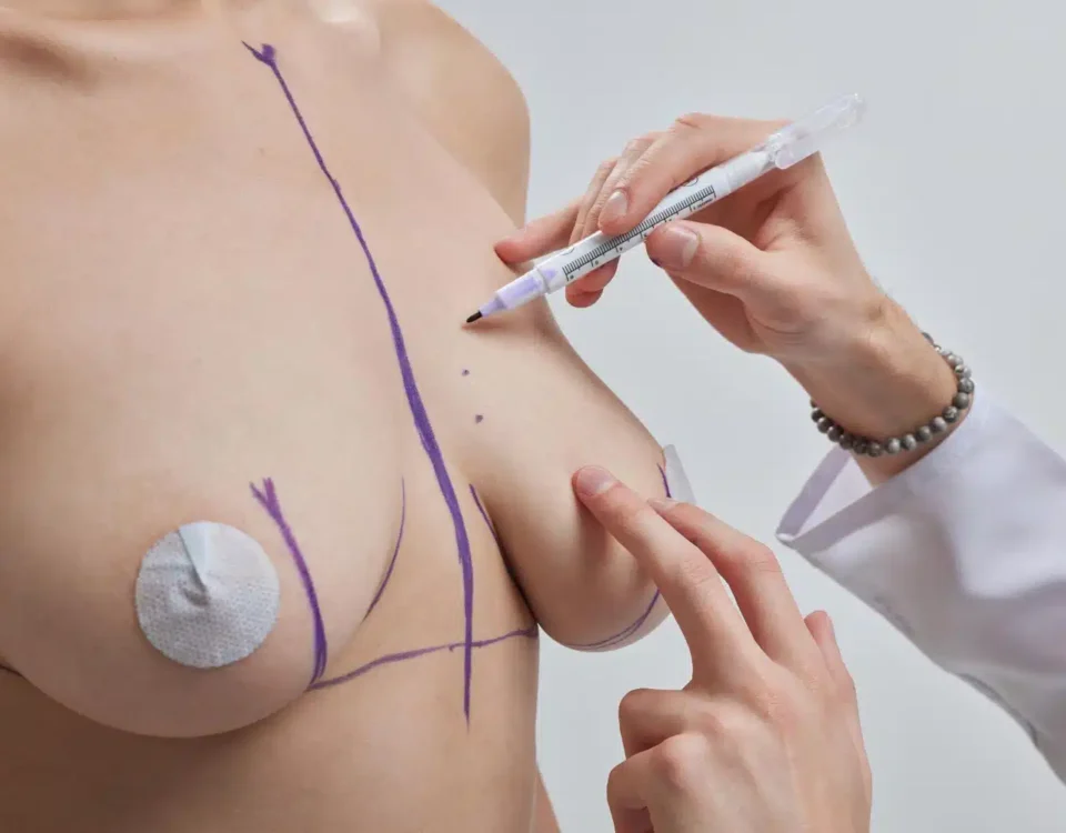 Mastopexie classique ou lifting mammaire avec auto-augmentation