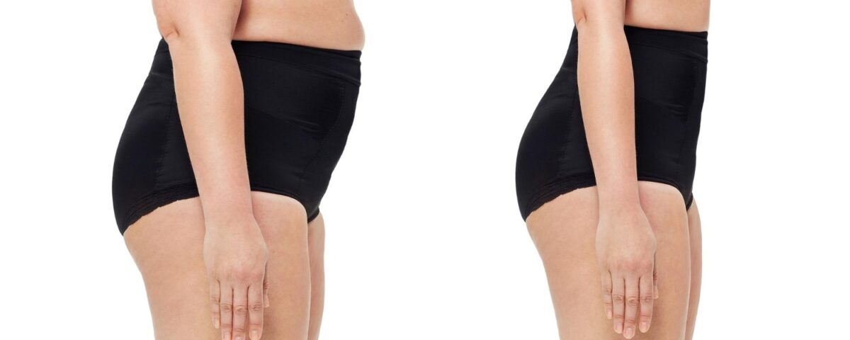Body Lift Inférieur et Lifting des Cuisses