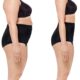 Body Lift Inférieur et Lifting des Cuisses