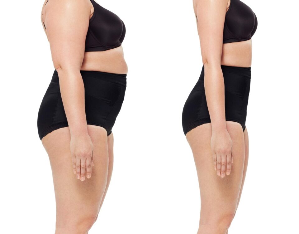Body Lift Inférieur et Lifting des Cuisses