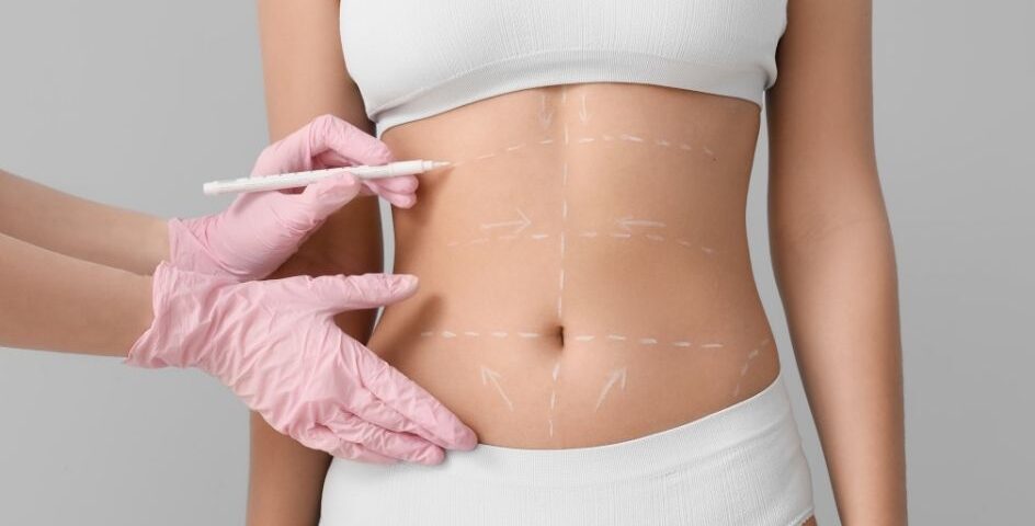 Lifting abdominal avec J-Plasma