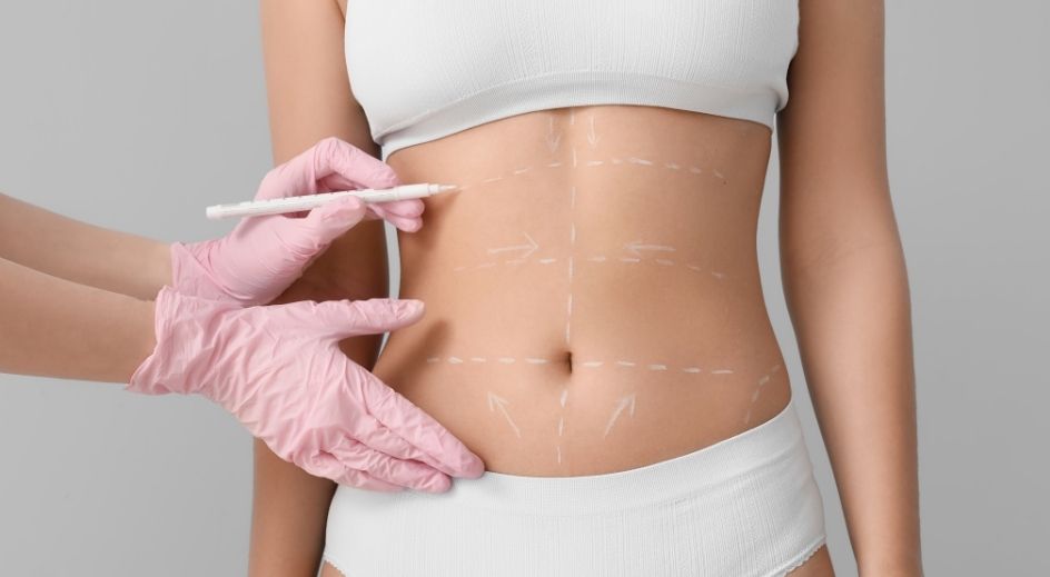 Lifting abdominal avec J-Plasma