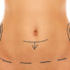 Lifting abdominal avec transposition de l’ombilic