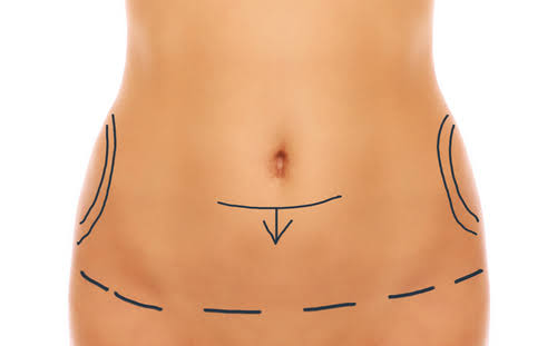 Lifting abdominal avec transposition de l’ombilic
