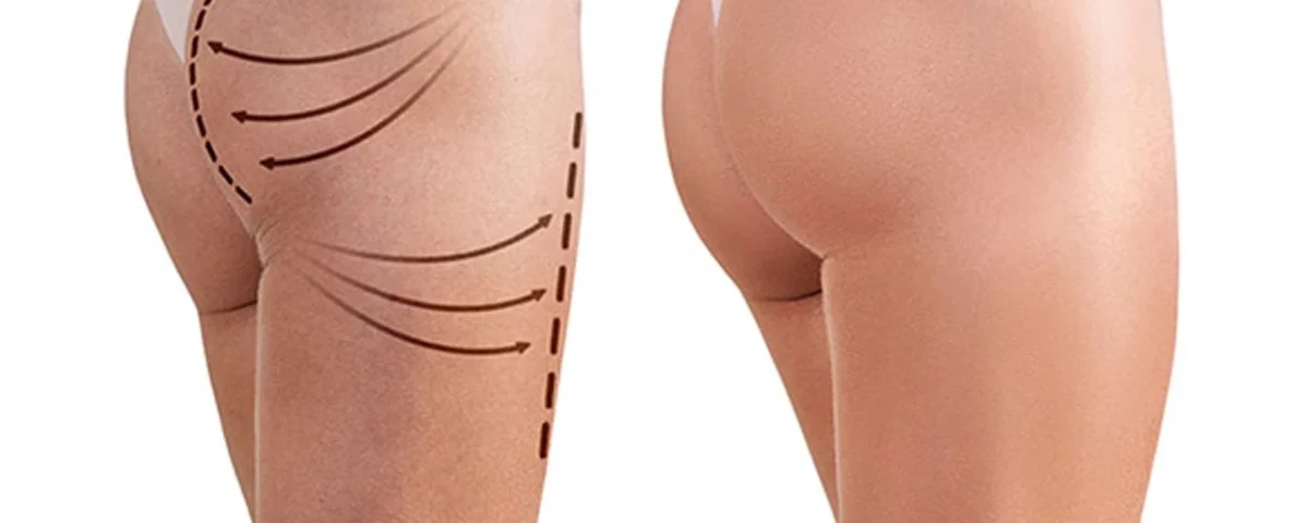 Lifting des fesses avec BBL échoguidé en Tunisie