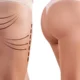 Lifting des fesses avec BBL échoguidé en Tunisie
