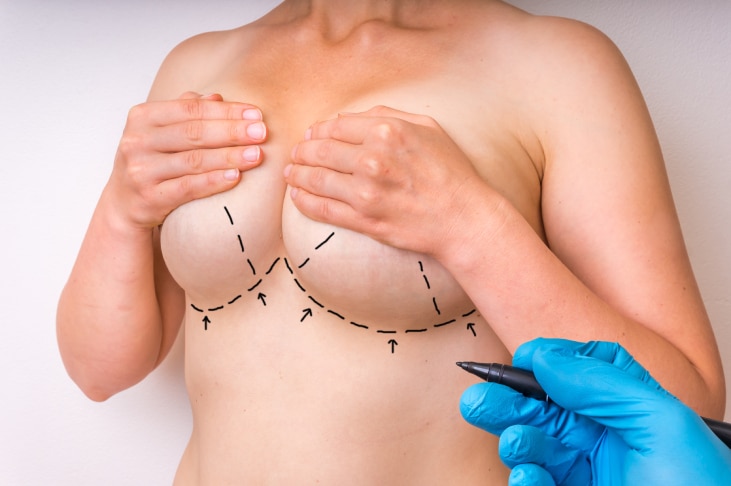 Lifting mammaire et lipofilling du décolleté